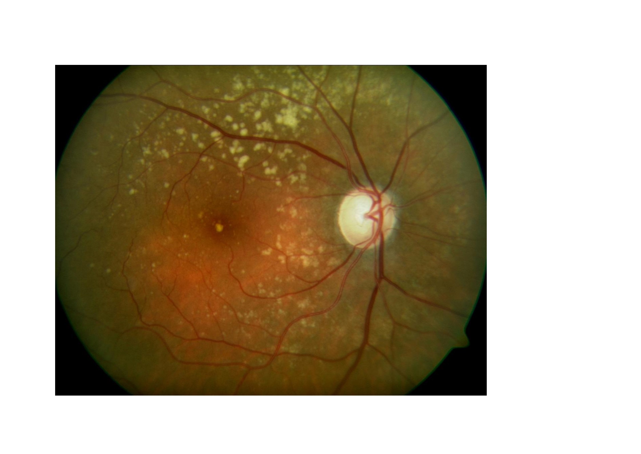 La severidad de la DMAE en un ojo predice la afectación del ojo contralateral.