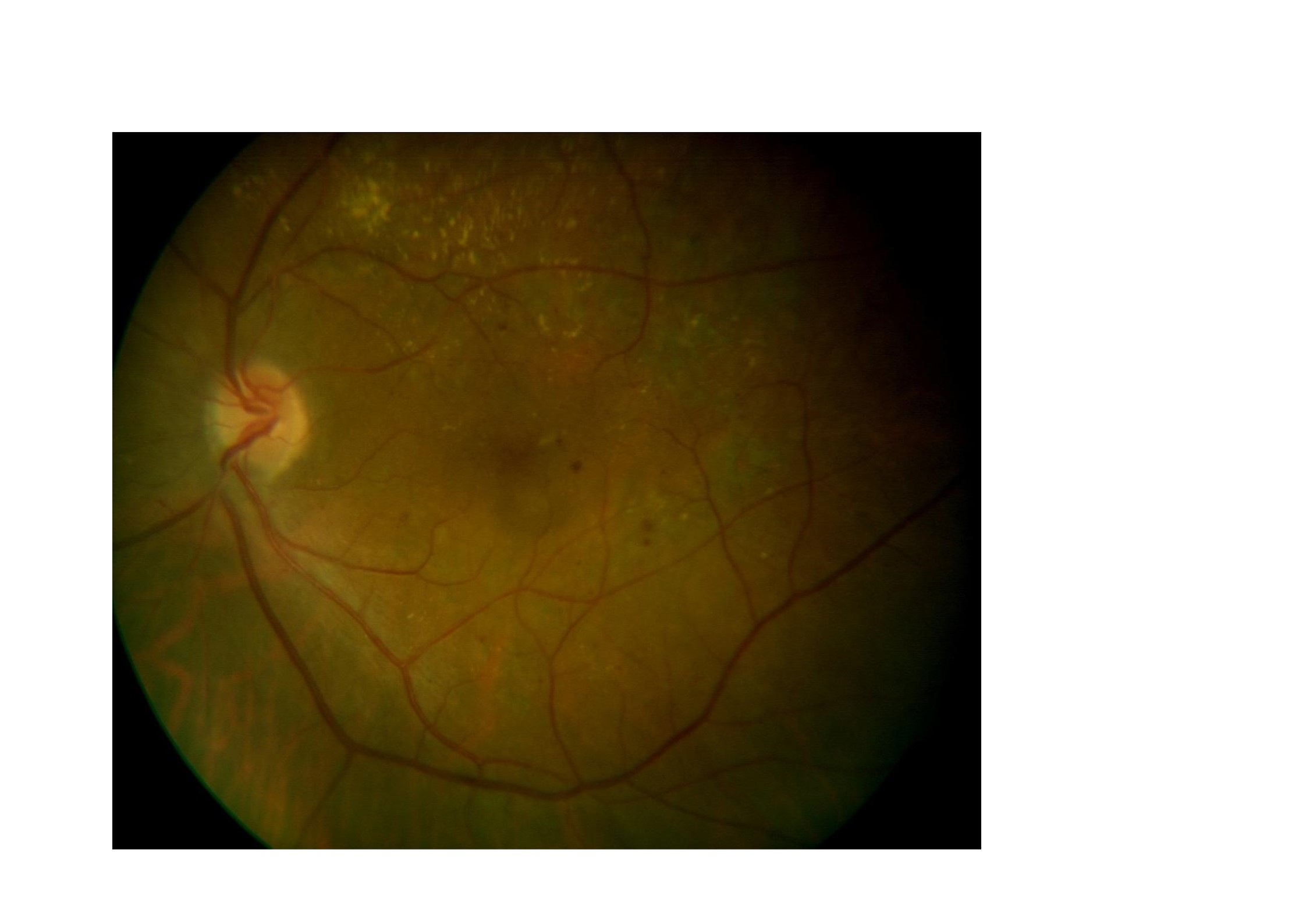 Ranibizumab disminuye los exudados lipidicos del edema macular diabético.