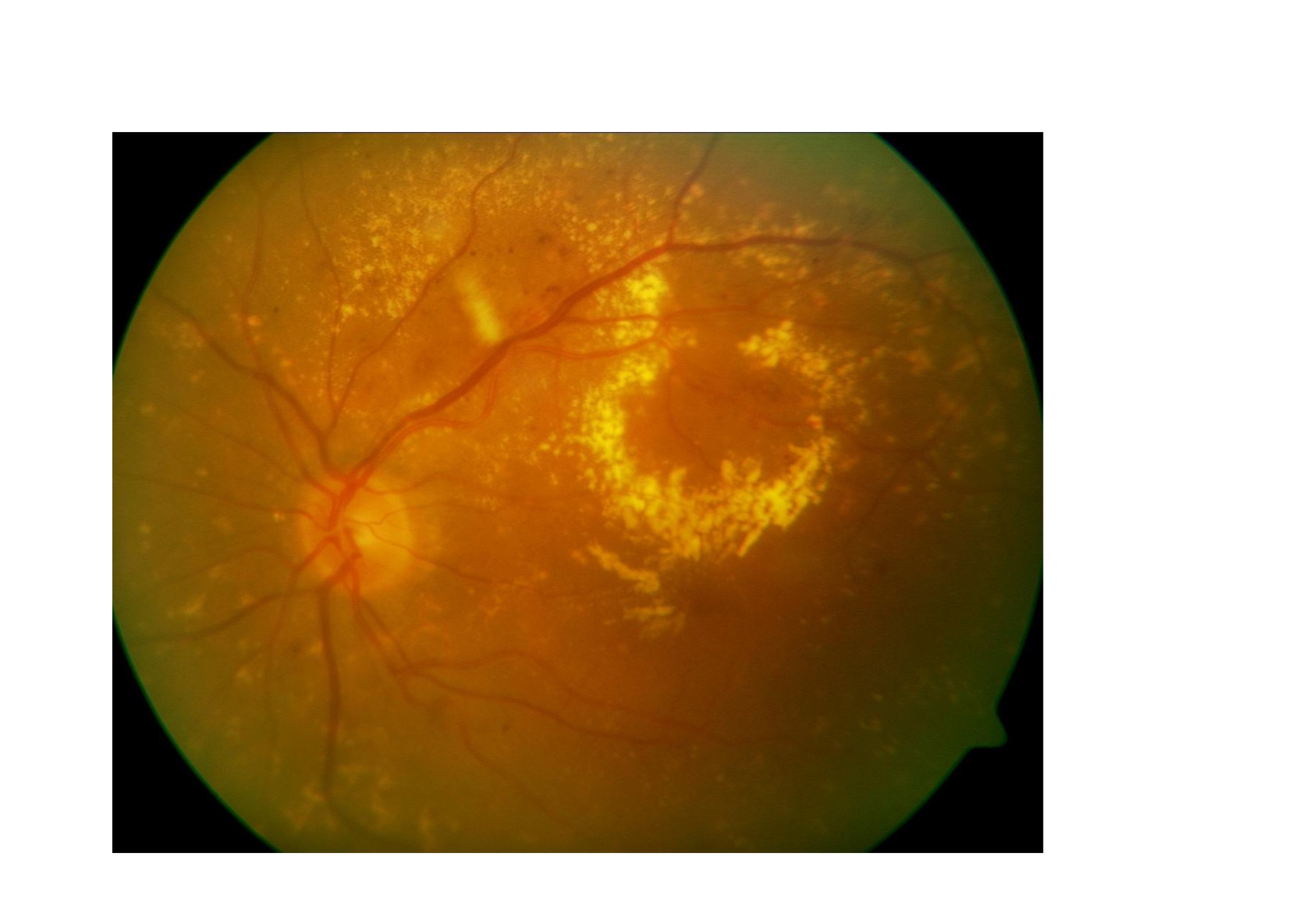 Ranibizumab en monoterapia o combinado con láser obtiene mejores resultados que el láser en monoterapia en el edema macular diabético.