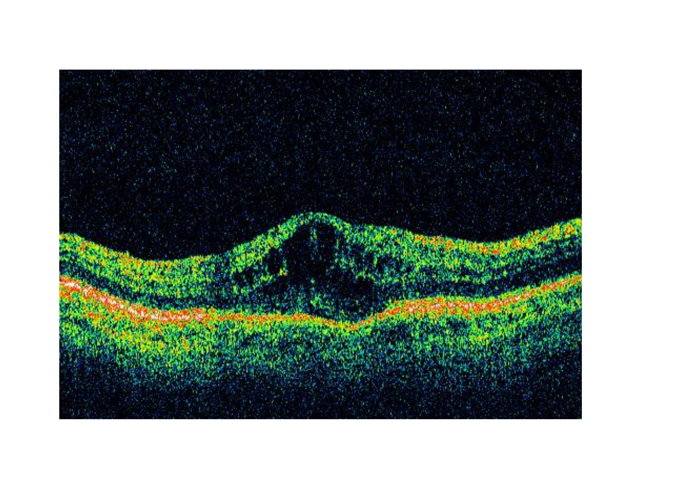 Los colirios de AINES tópicos son más efectivos que los de corticoides para prevenir el edema macular postquirúrgico.