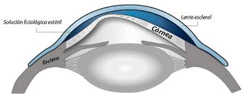 Detección, manejo y seguimiento optométrico del Queratocono