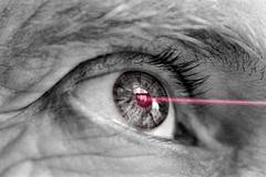 El laser femtosegundo mejora los retoque de LASIK hechos con microqueratomo