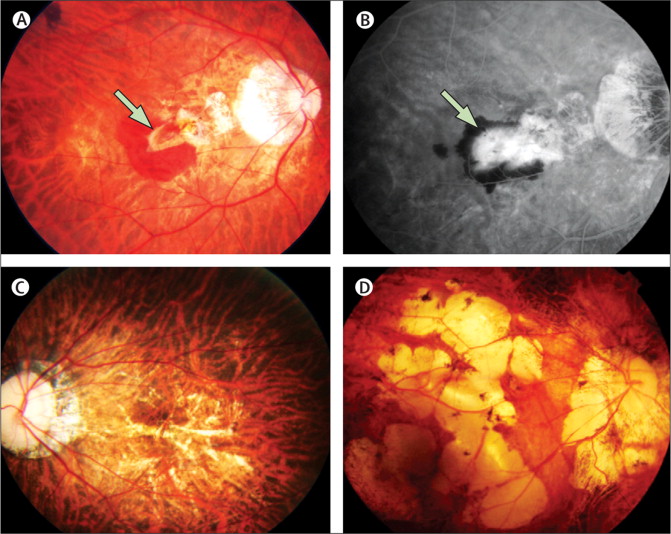 Resultado de imagen de pathological myopia