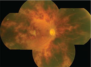 Vasculitis Retiniana Oclusiva Hemorrágica Asociada al uso de Vancomicina Intracameral