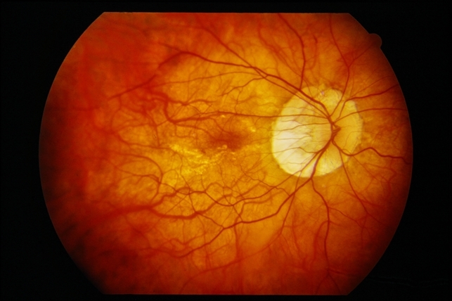 Resultado de imagen de retina high myopia