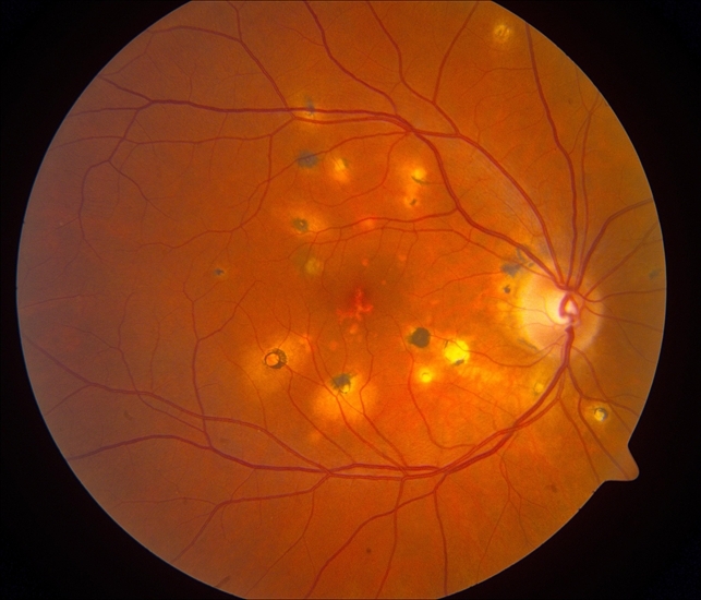 Resultado de imagen de multifocal choroiditis