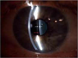 ICL: Vault mínimo en miopías elevadas