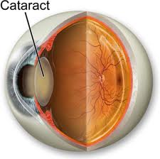 ¿Cuándo se tienen que operar las cataratas?