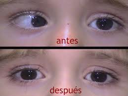 LASIK en niños: Endotropía Acomodativa Refractiva