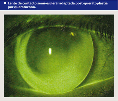 Aplicaciones actuales y eficacia de las lentes de contacto esclerales