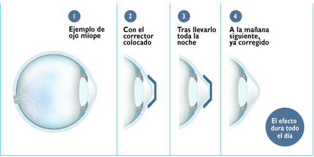Efecto de la Orto-k en la longitud del segmento anterior