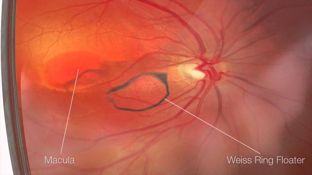 Resultado de imagen de vitreolisis