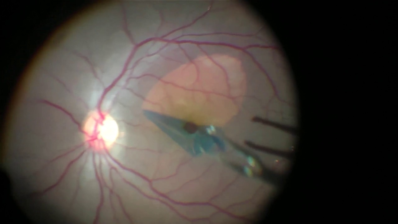 Resultado de imagen de inverted flap tecnique in macular hole