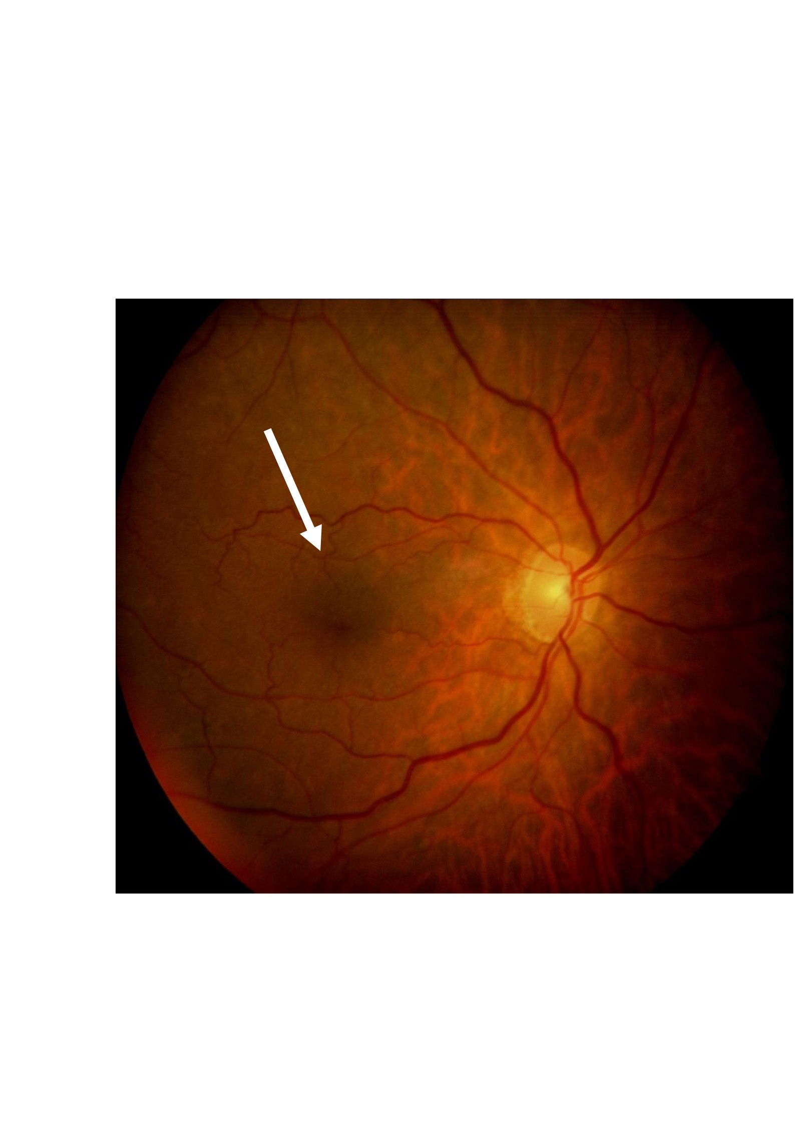 Nuestra experiencia en el tratamiento de la membrana epirretiniana