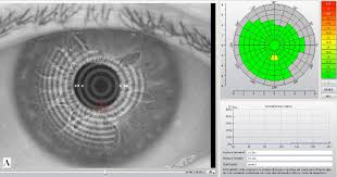 Alteración de la superficie ocular en usuarios de lentes de de contacto de hidrogel de silicona