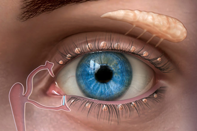 Cirugía Refractiva y Ojo Seco: Factores de Riesgo