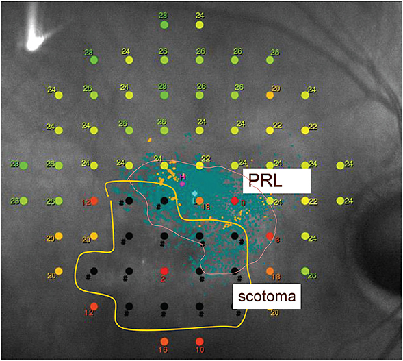 Resultado de imagen de maia microperimetry