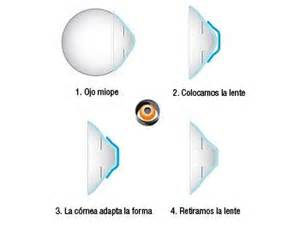 Ectasias.Orto-k