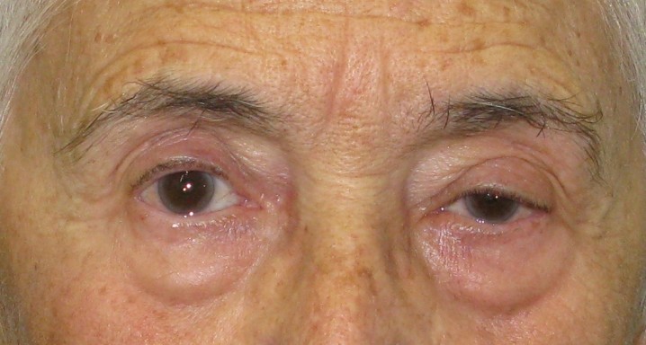 Ptosis palpebral tras cirugía ocular