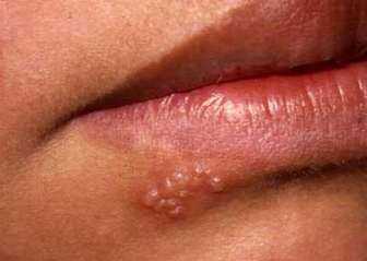 (1/6) Queratitis por herpes simple: epidemiología y microbiología