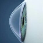 Qvision El Cross-Linking corneal en niños con queratocono mejora la agudeza visual queratocono 3