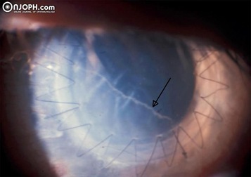Complejo Descemet-endotelio corneal en el diagnóstico del rechazo endotelial