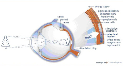Nuevos implantes en pacientes con Retinosis pigmentaria