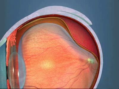 Alta Miopía y Cataratas