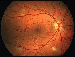 ¿Es la Miopía un Factor Protector en la Retinopatía Diabética?