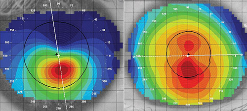 (1/3) Eficacia del Cross-Linking en el Queratocono: Análisis de 4 Meta-análisis