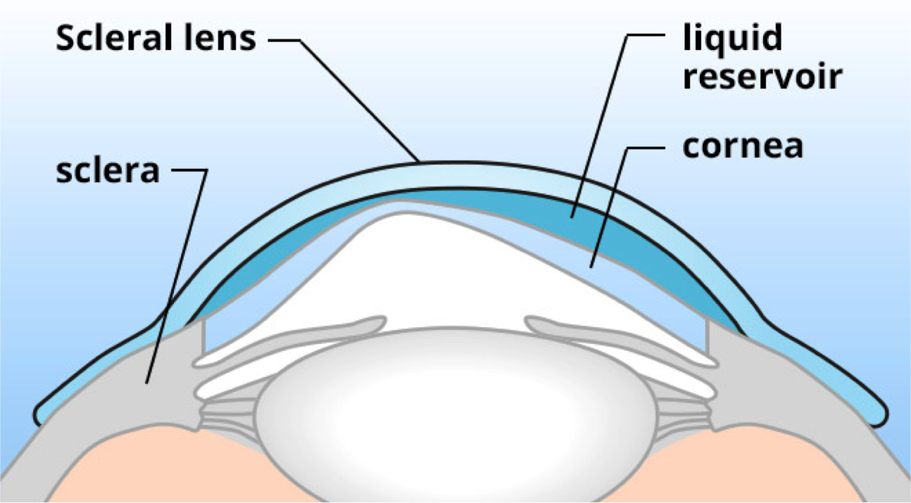 Evaluación de la PIO en el uso de lentes esclerales