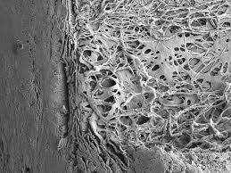 Glaucoma: elevación PIO tras inyección intravitrea anti-Vegf