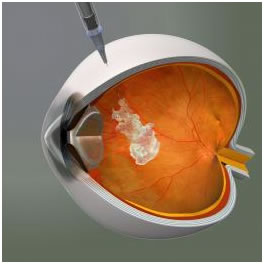 Degeneración Macular Asociada a la Edad Húmeda; ¿Estamos tratándola correctamente?